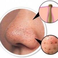 cara-menghilangkan-komedo-secara-alami-dan-cepat