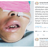 gegara-tukang-gigi-abal-abal-alami-infeksi-hingga-ditangani-4-dokter-spesialis