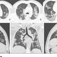 hasil-ct-scan-kasus-covid-19-di-perancis-telah-ada-sejak-november-2019