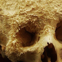 gak-kebayang-foto-tengkorak-yang-ketika-hidupnya-mengalami-kanker-tulang-parah