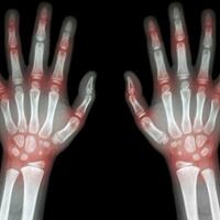 sering-menggunakan-mouse-dan-touchscreen-terancam-arthritis-benarkah-itu