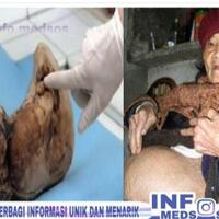 bayi-berusia-puluhan-tahun-ini-akhirnya-lahir-walaupun-dalam-keadaan-yang-mengerikan