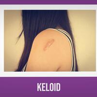 cara-menghilangkan-keloid