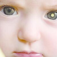 mengenal-retinoblastoma-penyakit-kanker-mata-yang-langka
