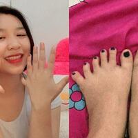 viral-gadis-pengidap-polidaktili-yang-memiliki-24-jari