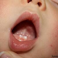 natal-teeth-fenomena-unik-bayi-tumbuh-gigi-sejak-baru-lahir-bukan-mistis