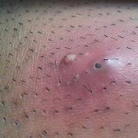 rambut-anda-tumbuh-ke-arah-dalam-kulit-ini-dia-fakta-seputar-ingrown-hair