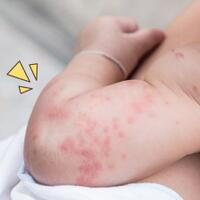 tangan-dan-kaki-mudah-bentol-atau-korengan-waspada-kemungkinan-gejala-darah-manis