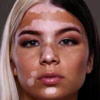 9-foto-kelainan-pada-kulit-manusia-yang-unik-dan-memiliki-keindahan-tersendiri