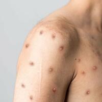 5-fakta-mengenai-virus-cacar-monyet-berbahayakah-ayo-cari-tau-gan