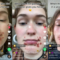 terkena-herpes-gara-gara-ciuman