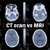 inilah-perbedaan-antara-ct-scan-dan-mri