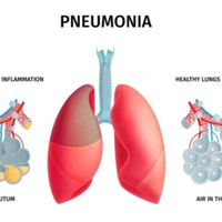 10-gejala-mycoplasma-pneumoniae-penyakit-berbahaya-sudah-masuk-indonesia