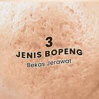 kenali-3-jenis-bopeng-bekas-jerawat