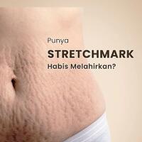 punya-stretch-mark-habis-melahirkan-yuk-temukan-solusinya