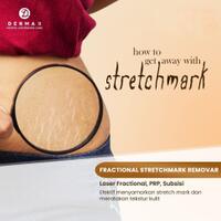 cara-menghilangkan-stretchmark-dengan-efektif