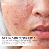 treatment-penyelamat-kulit-acne-prone
