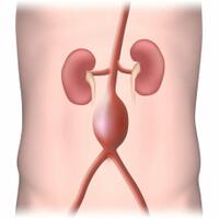 aneurisma-aorta-perut-penyebab-kematian-mendadak