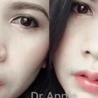 tren-di-thailand-wanita-operasi-bibir-agar-mirip-tanduk-kerbau