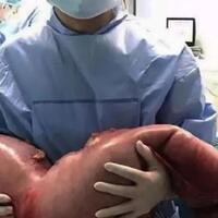 kotoran-manusia-seberat-13-kg-diangkat-dari-perut-pemuda-ini