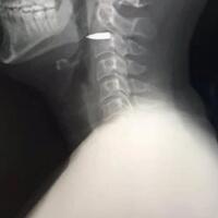 jurnalis-ini-membagikan-foto-x-raynya-setelah-tertembak-di-leher
