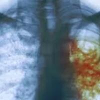 menuju-indonesia-bebas-tuberkulosis-v