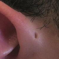 mengapa-sebagian-orang-punya-lubang-kecil-di-telinga-sinus-preauricular