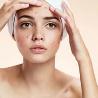 jerawat-kerap-muncul-di-tempat-yang-sama-ini-penyebabnya