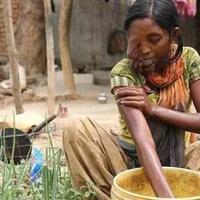 kasihan-gadis-india-ini-harus-menderita-hingga-ditinggal-ayahnya-gara-gara-ini