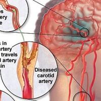 rajin-olahraga-tubuh-kekar-dan-baru-berusia-40-an-kok-bisa-kena-stroke