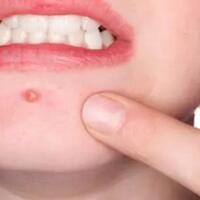 kesalahan-fatal-wanita-saat-menghilangkan-jerawat