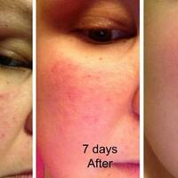 malu-karena-jerawat-4-produk-ini-bisa-menghilangkannya-dengan-cepat