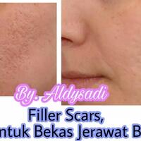 udah-nyobain-sis--filler-scar--solusi-untuk-bekas-jerawat-bopeng-aslinyalo