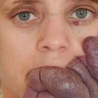 wanita-ini-menderita-port-wine-stain-yang-membuat-wajahnya-menjadi-seperti-ini