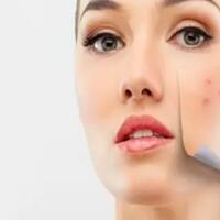 duh-ini-4-hal-yang-menyebabkan-noda-hitam-di-wajah