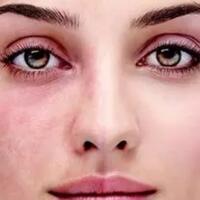 bingung-cara-ngerawat-kulit-sensitifmu-masuk-sini-sist