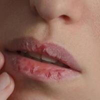 hati-hati-ternyata-hal-ini-bisa-memperparah-bibir-pecahmu