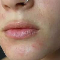 pengalaman-alergi-lipstick-dan-penanganannya-ala-ane-sista-wajib-baca