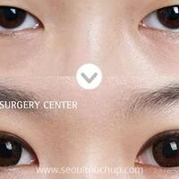 ini-jenis-operasi-plastik-paling-banyak-peminatnya-di-korea-selatan