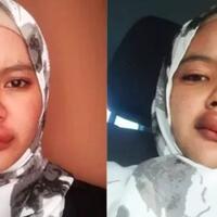 lupa-pakai-masker-saat-naik-motor-bibir-wanita-ini-di-gigit-serangga-sampai-bengkak