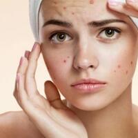 beda-letak-jerawat-beda-pula-penyebab-dan-penanganannya-yuk-disimak