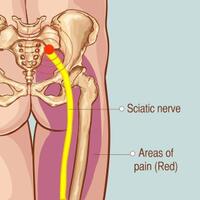 pengalaman-ane-kena-sindrom-piriformis-lawan-kaum-rebahan