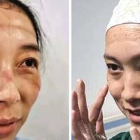 potret-wajah-perawat-virus-corona-china-wajah-lebam-membiru-karena-masker