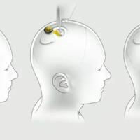 neuralink-teknologi-yang-bisa-mengontrol-internet-hanya-dengan-otak