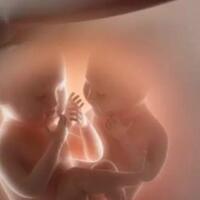 waspada-mirror-syndrom-dan-ttts-moms-penyebab-meninggalnya-bayi-kembar-irish-bella