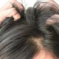 rambutmu-kutuan-pakai-ramuan-ini-ya