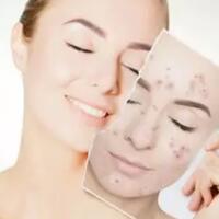 usir-jerawat-membandel-dengan-mudah-dan-murah