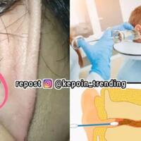 hati-hati-saat-korek-kuping-dengan-cotton-bud-tanpa-disadari-bisa-menyebabkan-bahaya