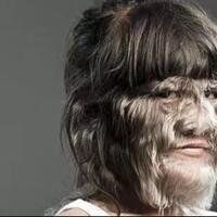 bukan-adzab-atau-kutukan-mari-mengenal-hypertrichosis-fenomena-manusia-serigala