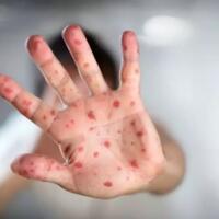 mewabah-di-12-negara-ini-dia-gejala-penularan-dan-pencegahan-virus-cacar-monyet